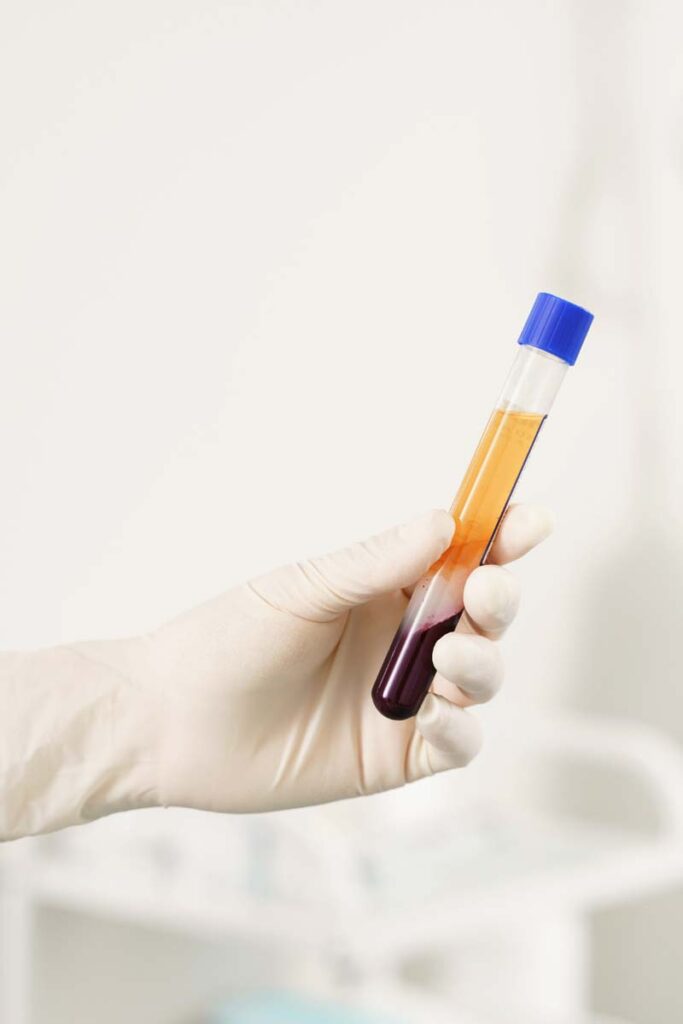 PRF - Plasma Rico en Fibrina
